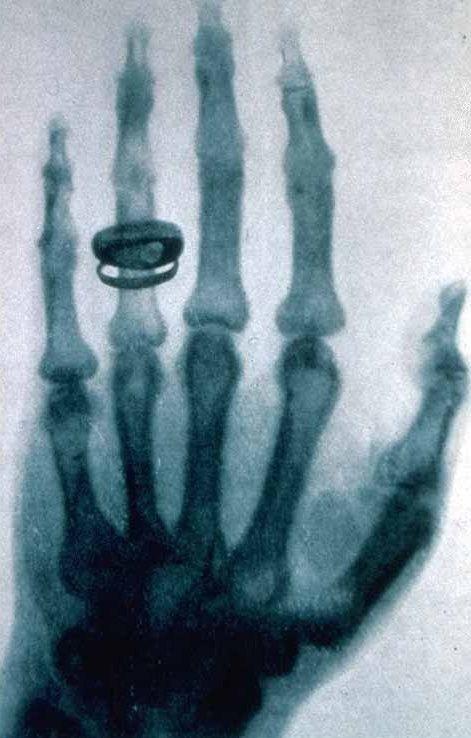 Une des premières radiographies effectuées par Röntgen.