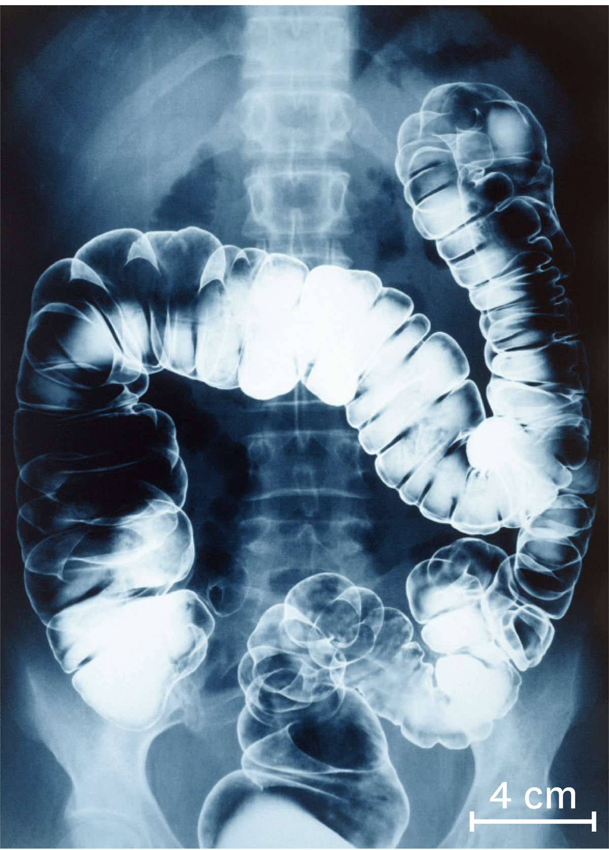 Une radiographie du gros intestin chez un être humain 10 à 15 heures après ingestion du produit.