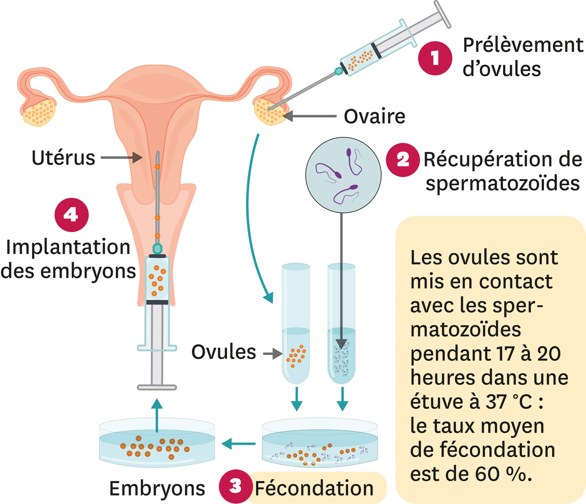 Le principe de la FIVETE (Fécondation In Vitro Et Transfert d'Embryon).