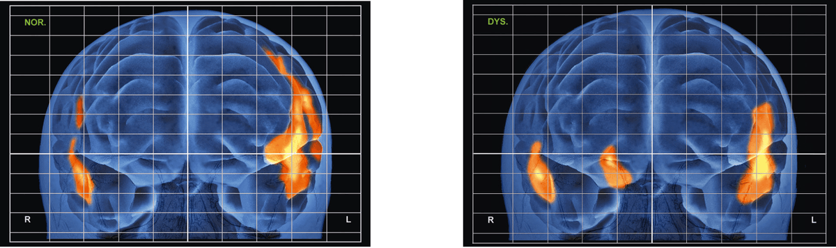Les activations cérébrales d'un patient témoin (gauche) ou dyslexique (droite) en train de lire. Il s'agit d'une reconstruction 3D du cerveau.