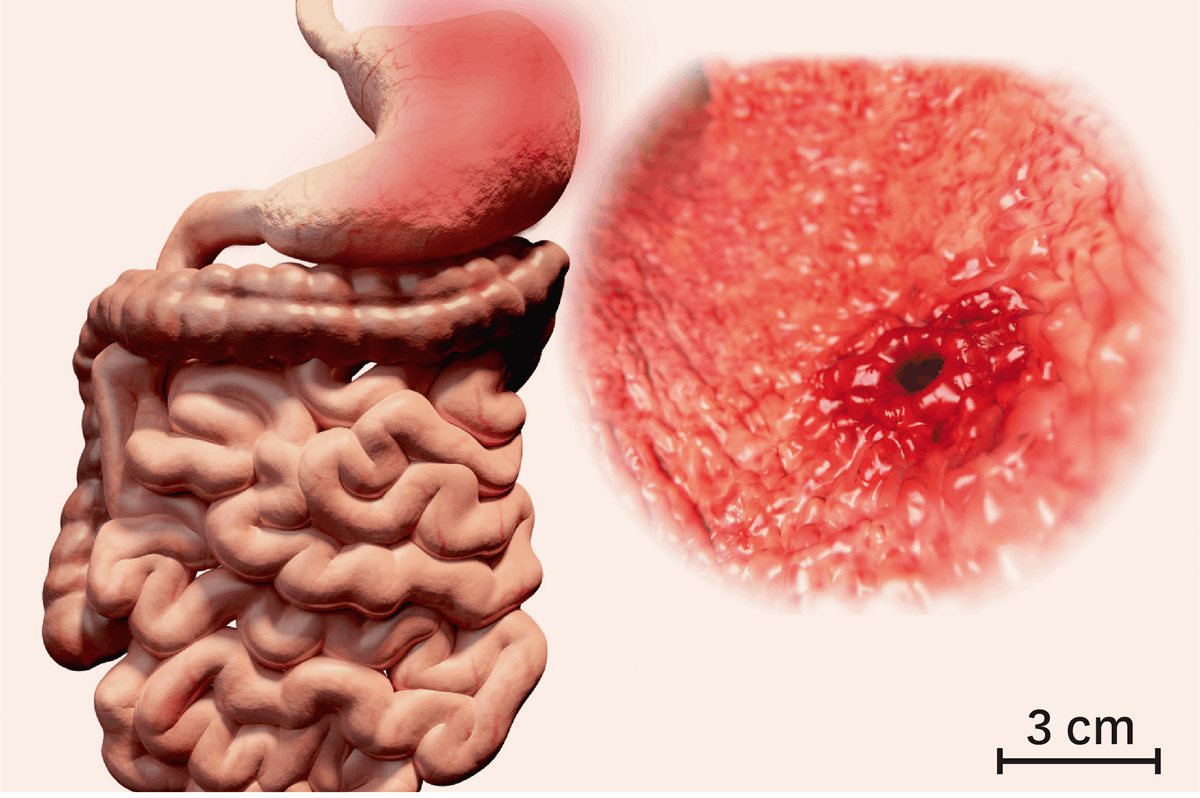 Illustration de l'ulcère gadtrique'ulcère gastrique