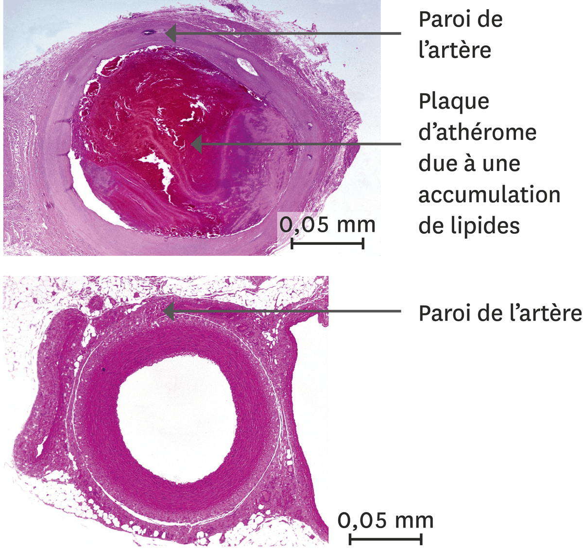 Une comparaison entre une artère d'un orteil en nécrose (en haut) et d'une artère normale (en bas).