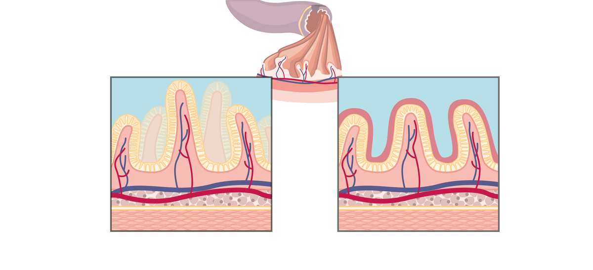 Schéma comparatif des villosités (en coupe transversale) d'un intestin normal (à gauche) et d'un intestin d'une personne intolérante au gluten mais n'ayant pas encore modifié son alimentation (à droite).