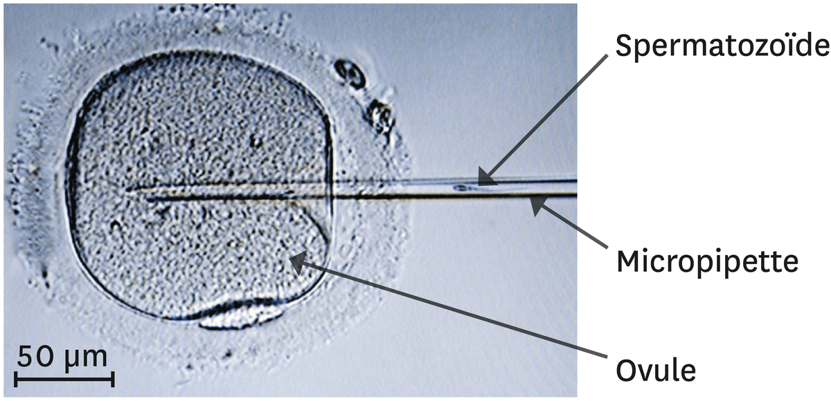  Le principe de l'ICSI (injection intracytoplasmique de spermatozoïde).