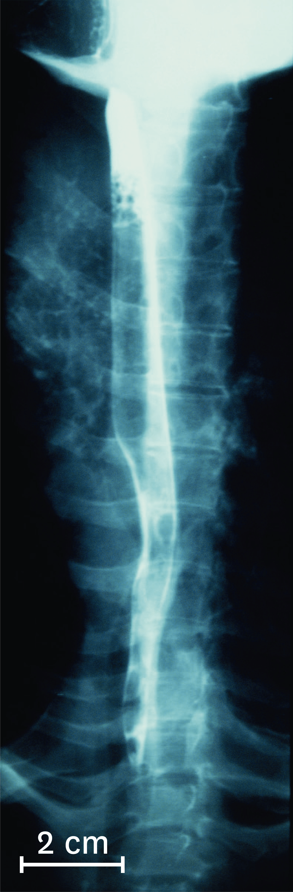 Une radiographie de l'oesophage chez un être humain, quelques secondes après ingestion du produit visible aux rayons X.