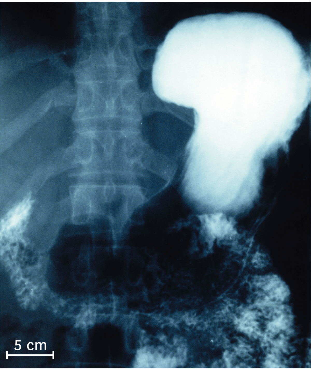 Une radiographie de l'estomac chez un être humain 2 à 6 heures après ingestion du produit.