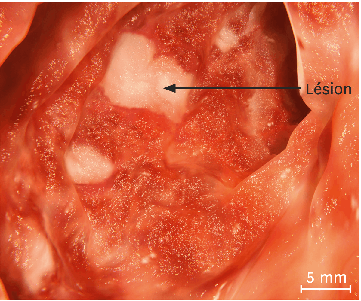 Une vue endoscopique d'un gros intestin atteint de colite.