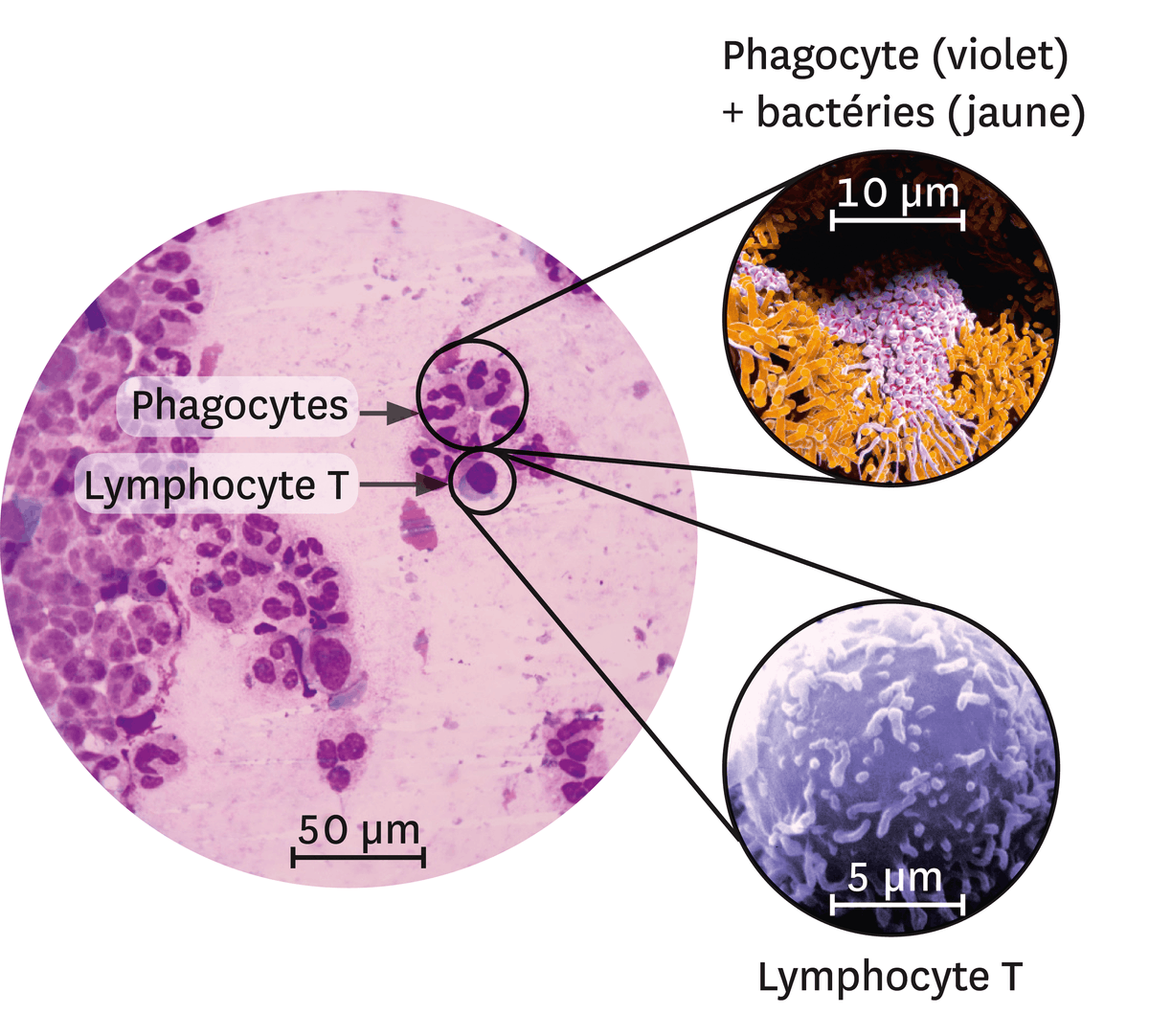 Différents types de leucocytes sur le site d'une infection. On fait un zoom sur le phagocyte (en violet) + des bactéries (en jaune) et les lymphocyte T